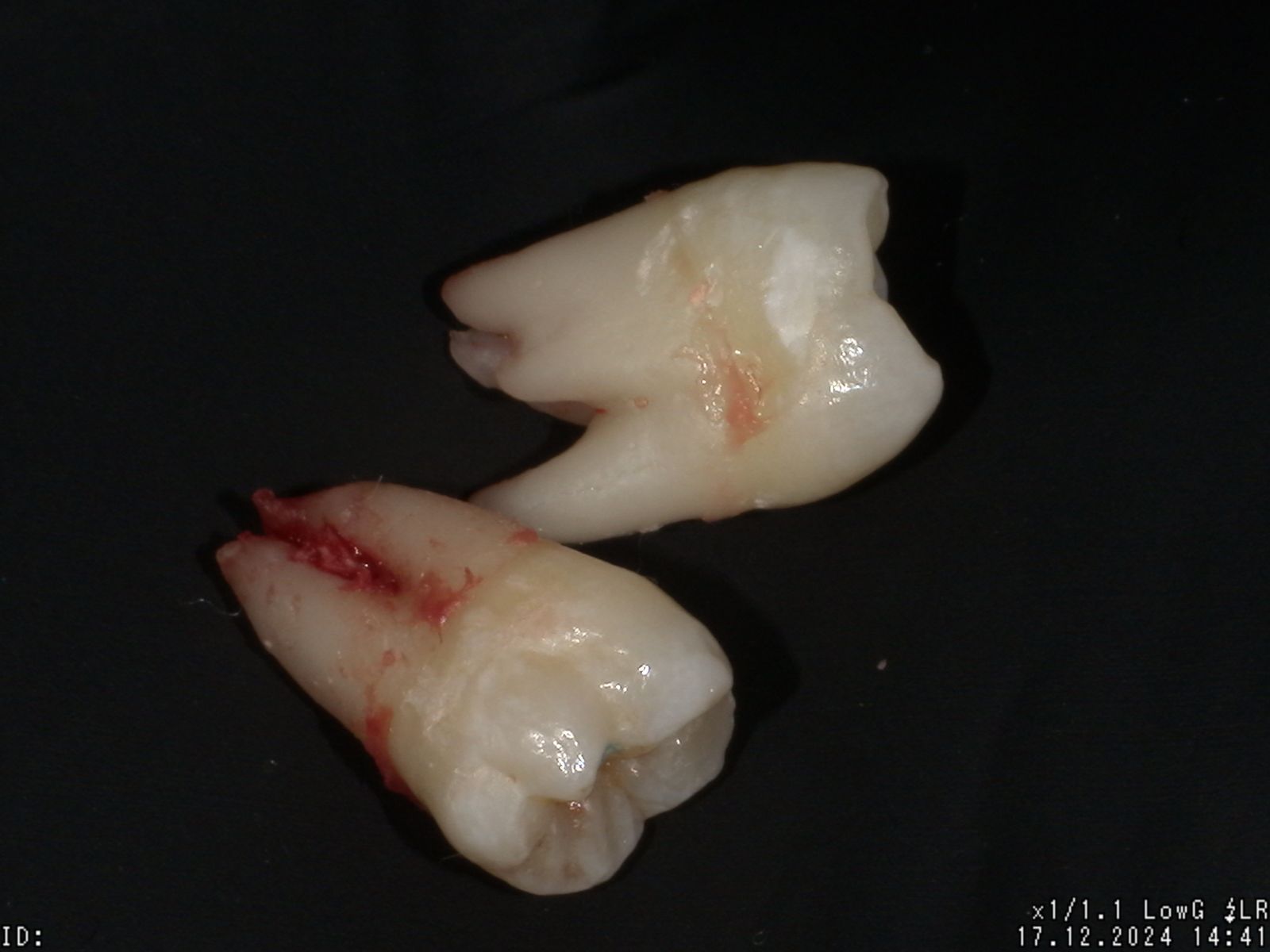 Wisdom Teeth Removal in Hamilton: Expert Oral Surgery on Hamilton Mountain
