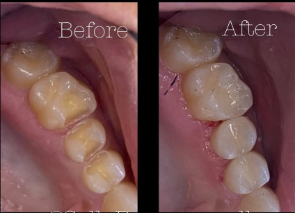 Restorative dentistry, fillings, crowns and bridges at Hamilton Care Dental Centre