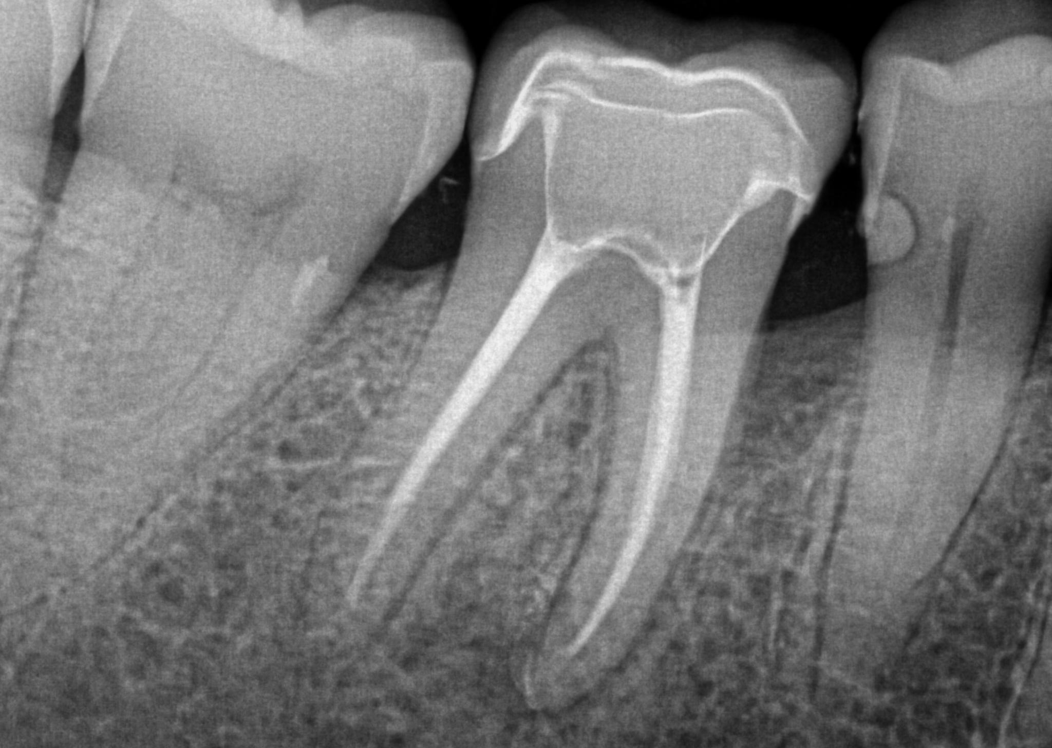 Endodontics (Root Canals) at Hamilton Care Dental Centre in Hamilton, Ontario