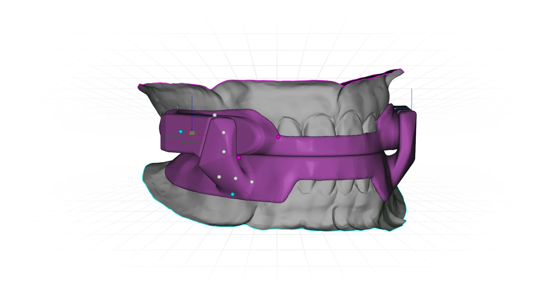 Sleep apnea and snoring oral appliance therapy at Hamilton Care Dental Centre, view one