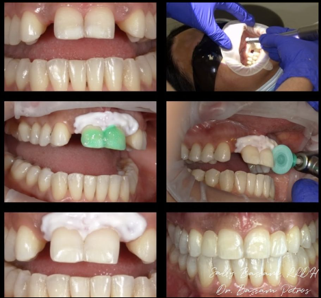 Cosmetic dentistry, veneers and smile makeovers at Hamilton Care Dental Centre