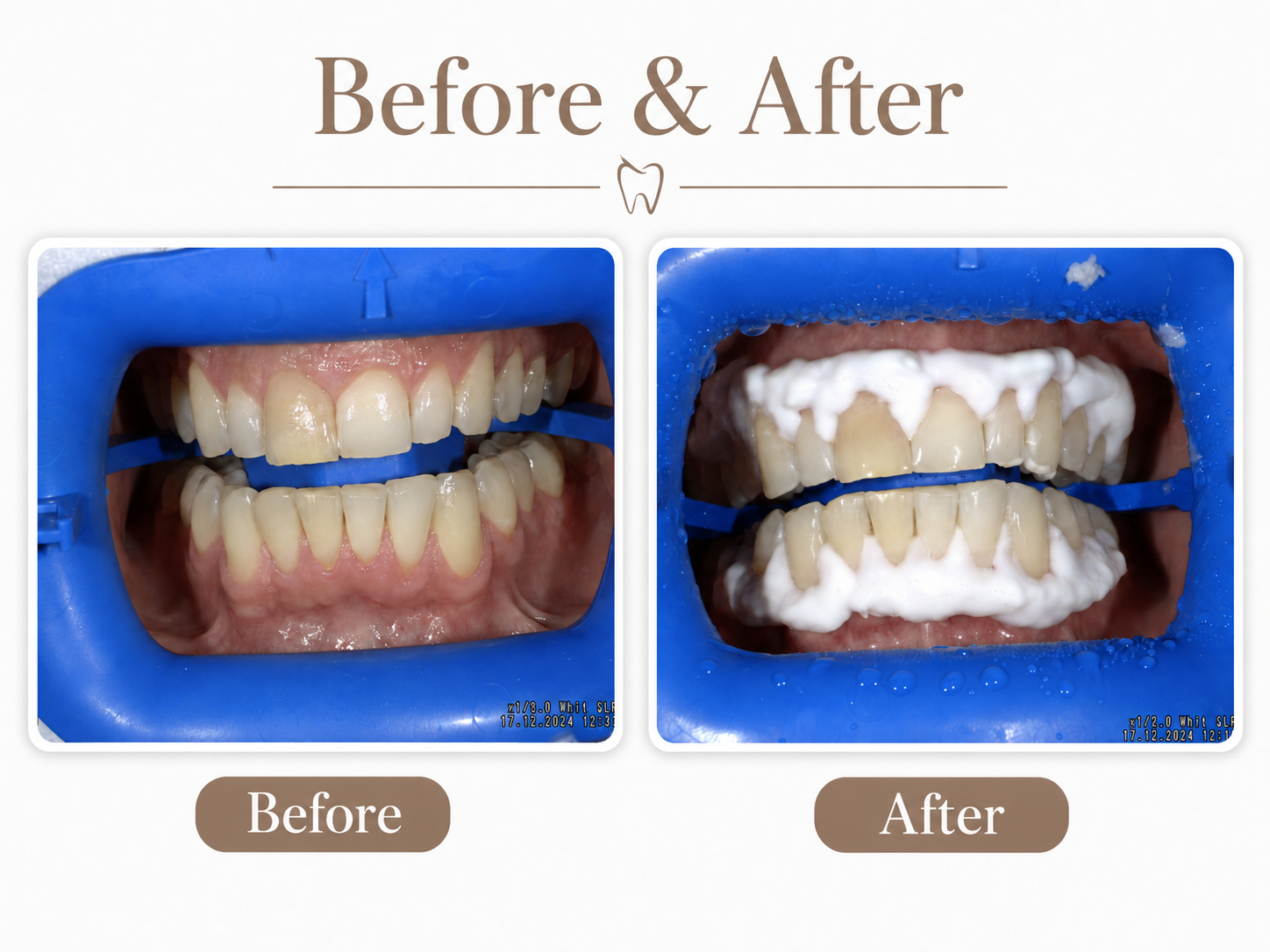 Zoom and take-home teeth whitening at Hamilton Care Dental Centre, view one