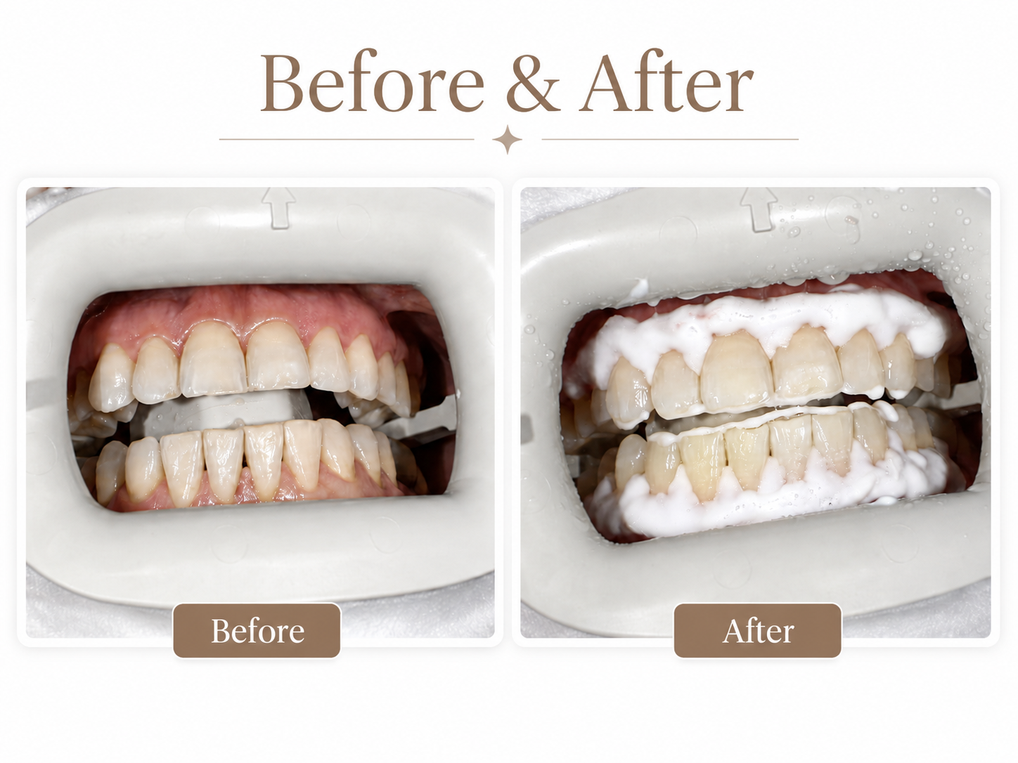 Zoom and take-home teeth whitening at Hamilton Care Dental Centre, view two