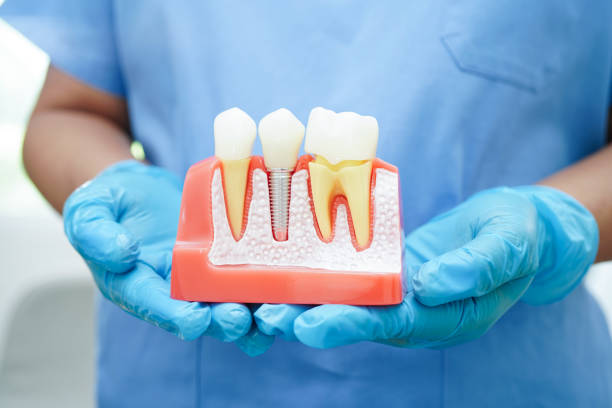 Dental implant model