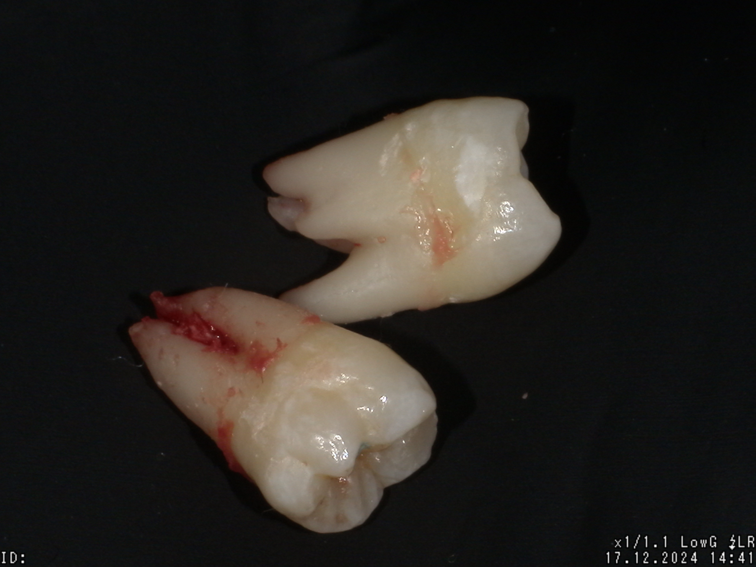 Oral surgery and wisdom teeth removal